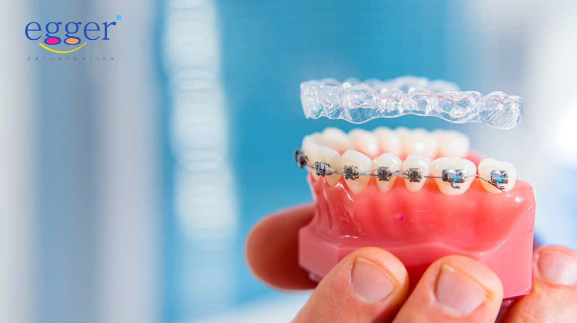Invisalign vs Braces- Which Is Right For Your Smile?